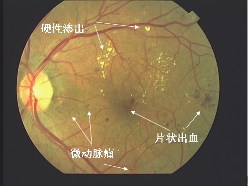 糖尿病并发症