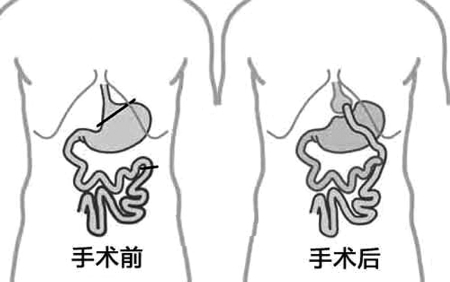 糖尿病胃转流手术