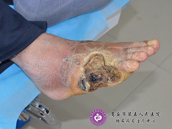 图 截趾后烤干表面形成一层痂皮,但下面却发生着严重的感染